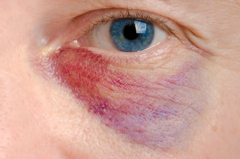eye injury